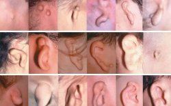 郑州民生耳鼻喉医院携手北京外耳再造专家团队为19名小朋友“圆梦新耳”！
