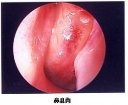 民生医院：浅谈鼻息肉的危害