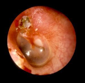 耳朵里长包像疙瘩是胆脂瘤吗？什么是胆脂瘤型