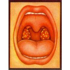 扁桃体炎是一种什么病精 扁桃体炎是耳鼻咽喉科较为常见的疾病,很多