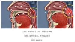 腺样体肥大-儿童颜值的隐形杀手